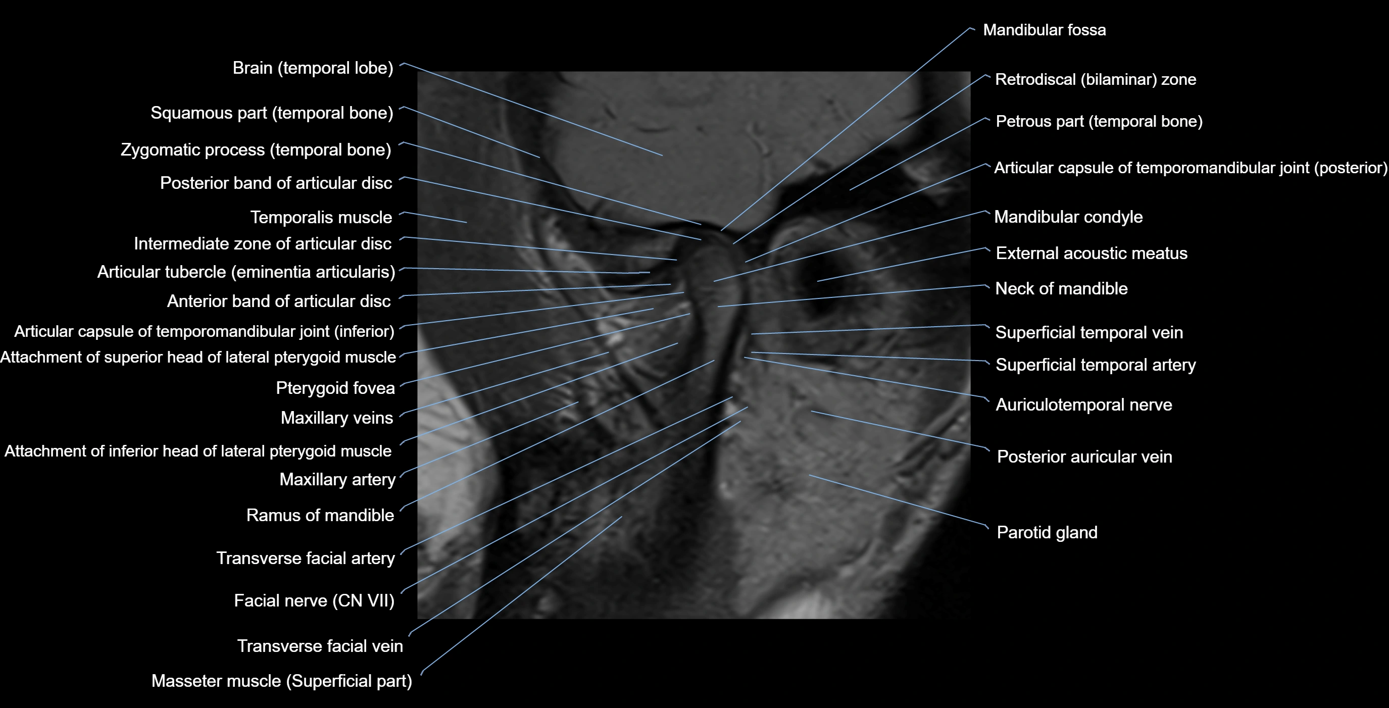 MRI TMJ sagittalclosed  mouth cross sectional 3T anatomy -img-00001-00007.webp